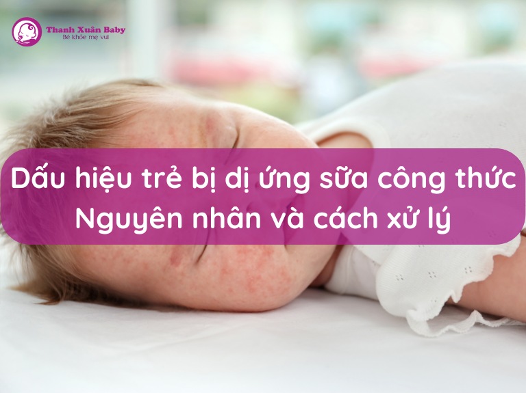 dau-hieu-tre-bi-di-ung-sua-cong-thuc-nguyen-nhan-va-cach-xu-ly