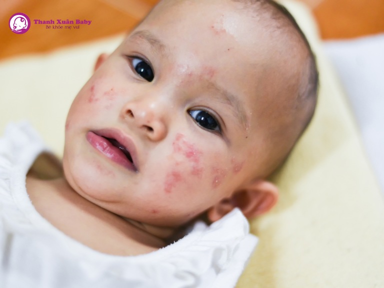 tại sao bé lại bị ứng sữa công thức